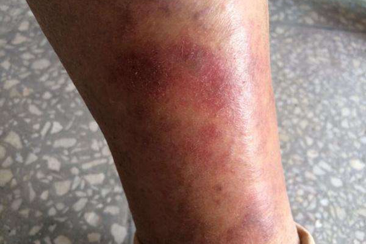 慢性淤积性皮炎图