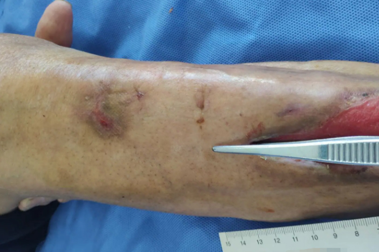 伤口潜行图 伤口潜行图