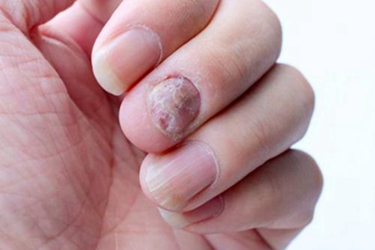 慢性甲沟炎手指甲症状图