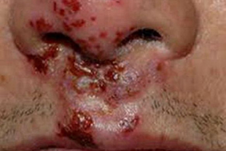 口唇疱疹口周红色糜烂图