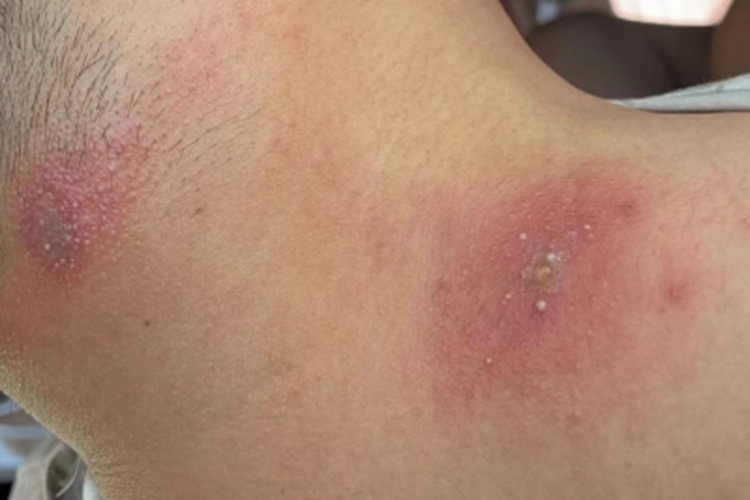 昆虫性皮炎侧颈脓包图