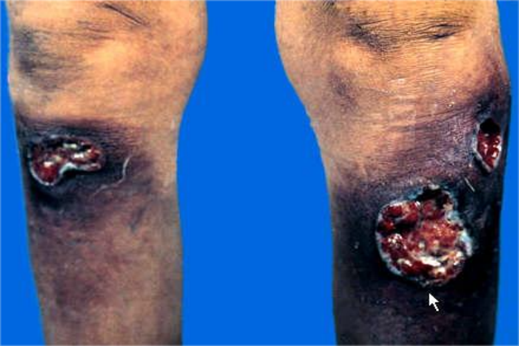 梅毒小腿梅毒性树胶肿图