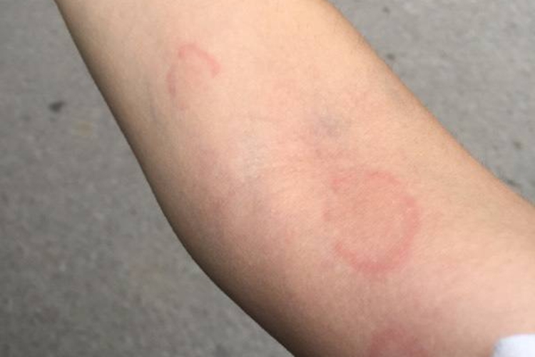 手臂癣圆癣图 手臂癣圆癣图