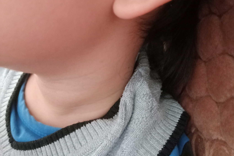 小孩脖子中间有一圈肉图片