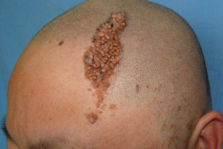 皮脂腺痣头皮上有多个黄色结节图