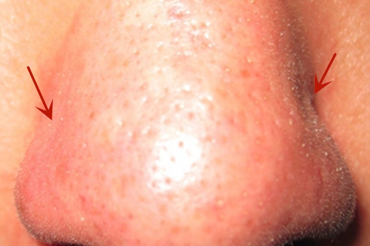 皮脂溢出白头粉刺图