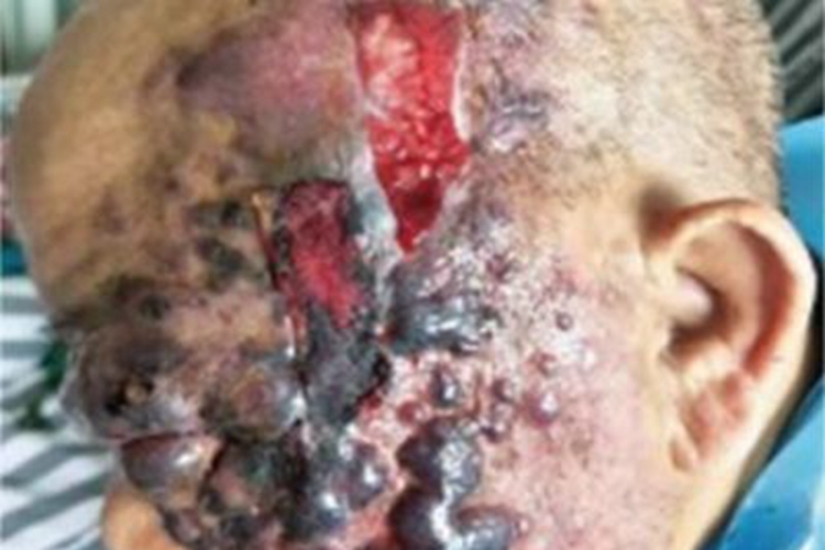 特发性头颈部血管肉瘤面部糜烂图 特发性头颈部血管肉瘤面部糜烂图