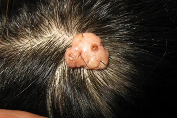 软纤维瘤头皮症状图