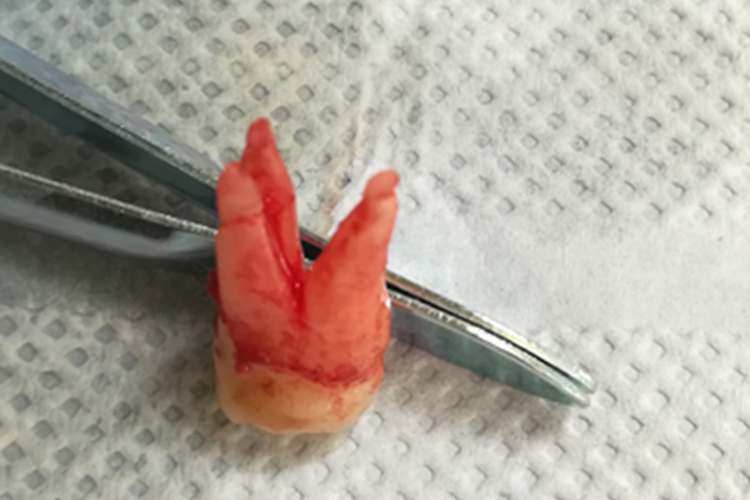 第一前磨牙牙根图