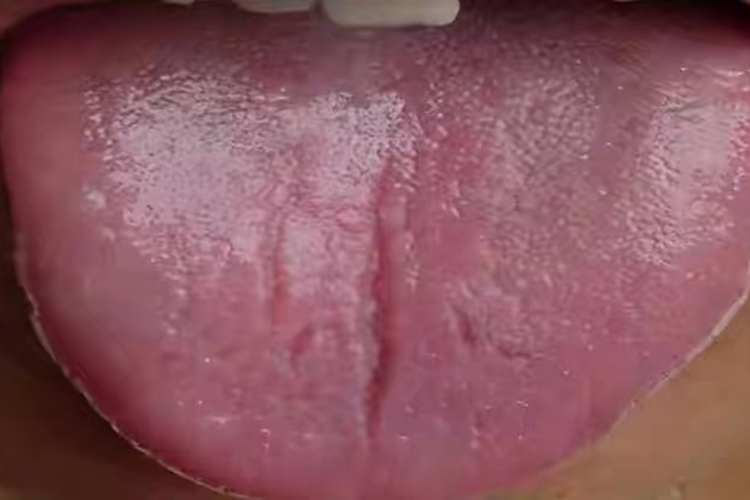 阴虚火旺舌红少苔有裂纹图