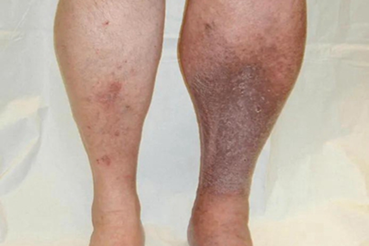 下肢深静脉血栓形成水肿图 下肢深静脉血栓形成水肿图