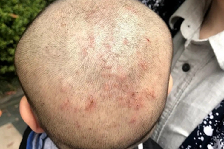 儿童期特应性皮炎头皮症状图 儿童期特应性皮炎头皮症状图