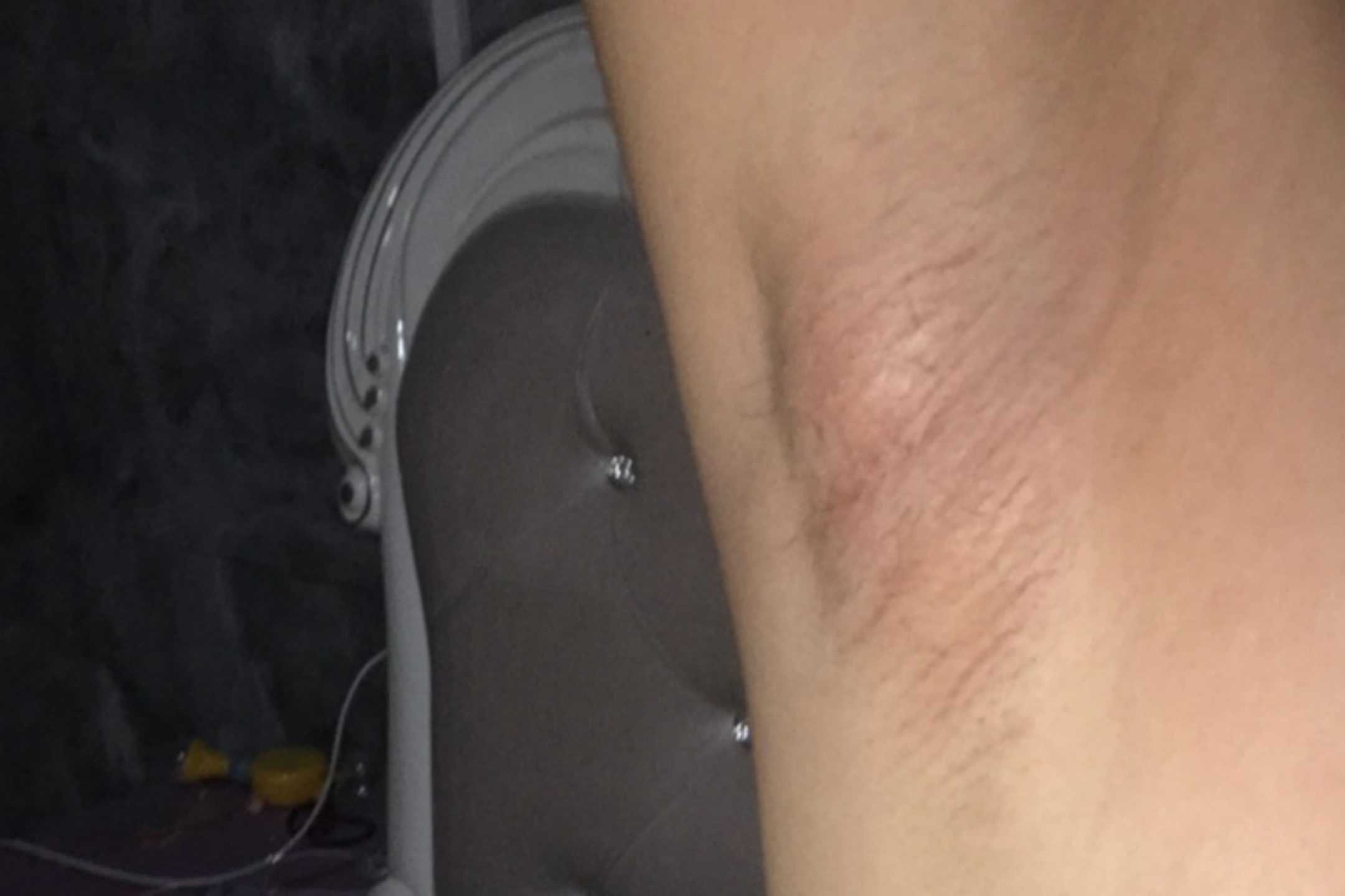 女性自身免疫性疾病腋下淋巴结肿大图 女性自身免疫性疾病腋下淋巴结肿大图