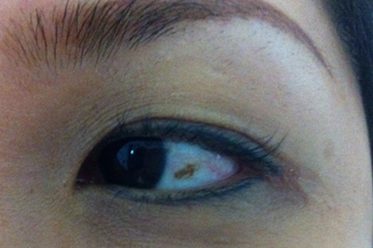 家族性进行性色素沉着眼球斑图