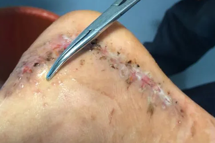 伤口真菌感染图