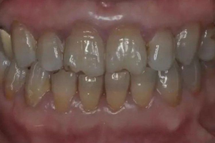 重度四环素牙