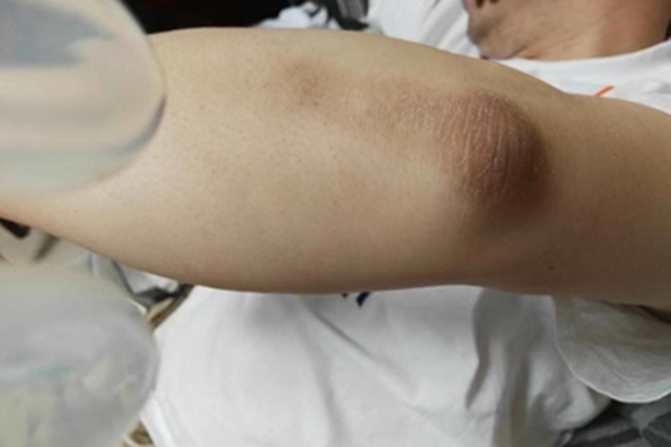 神经性皮炎斑图 神经性皮炎斑图