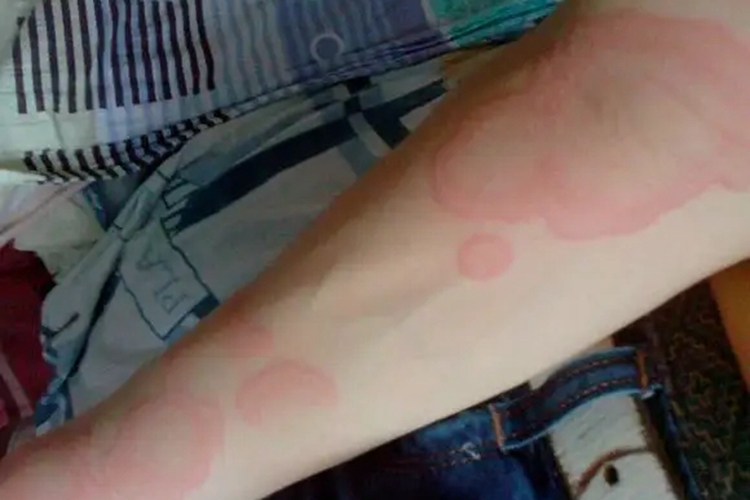 钱币状湿疹融合红斑图