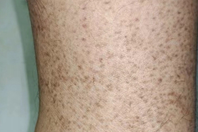 进行性色素性紫癜性皮病斑图