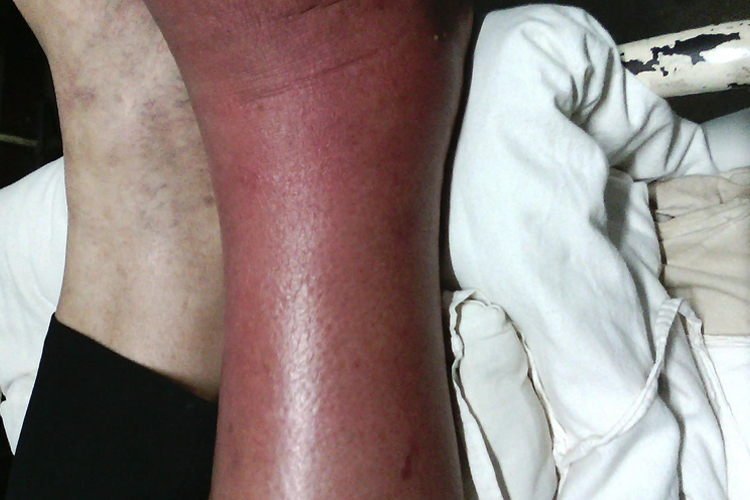 丹毒样型癣菌疹症状图 丹毒样型癣菌疹症状图