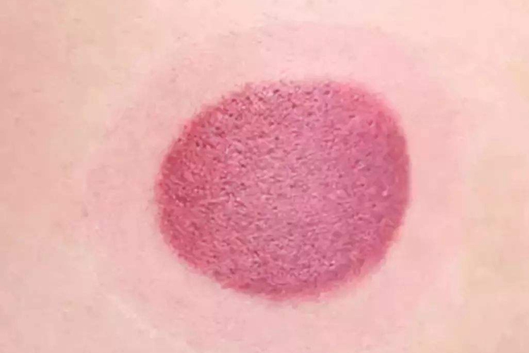 拔罐后皮肤鲜红色图 拔罐后皮肤鲜红色图