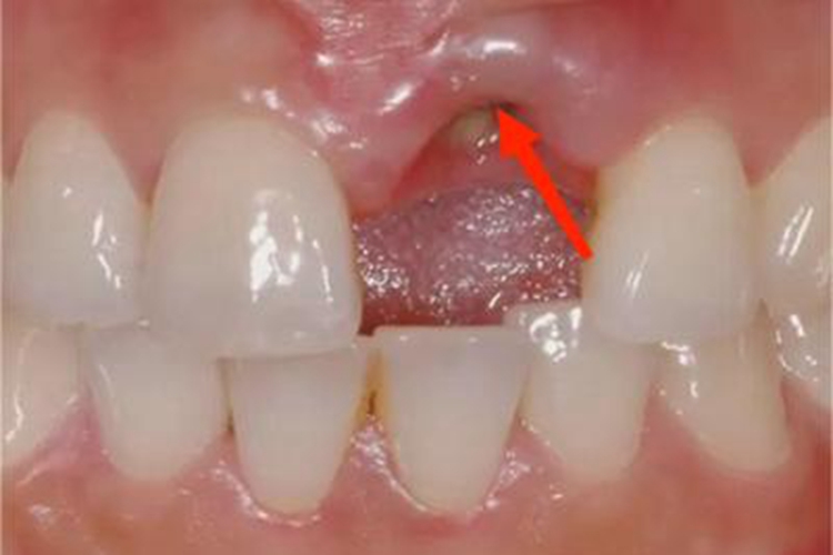 急性坏死性龈口炎牙龈小疙瘩图 急性坏死性龈口炎牙龈小疙瘩图