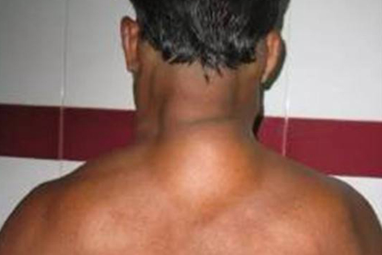 脖子脂肪瘤晚期图