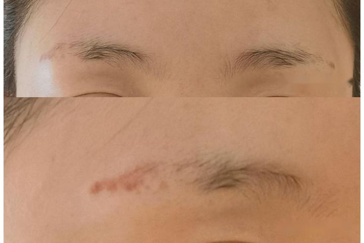 无创洗眉3-4天变化图