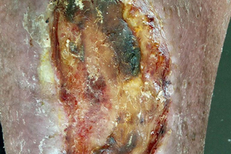 坏疽性臁疮结痂图 坏疽性臁疮结痂图