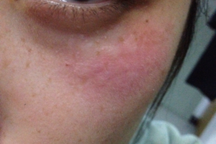 体虱病面部症状图