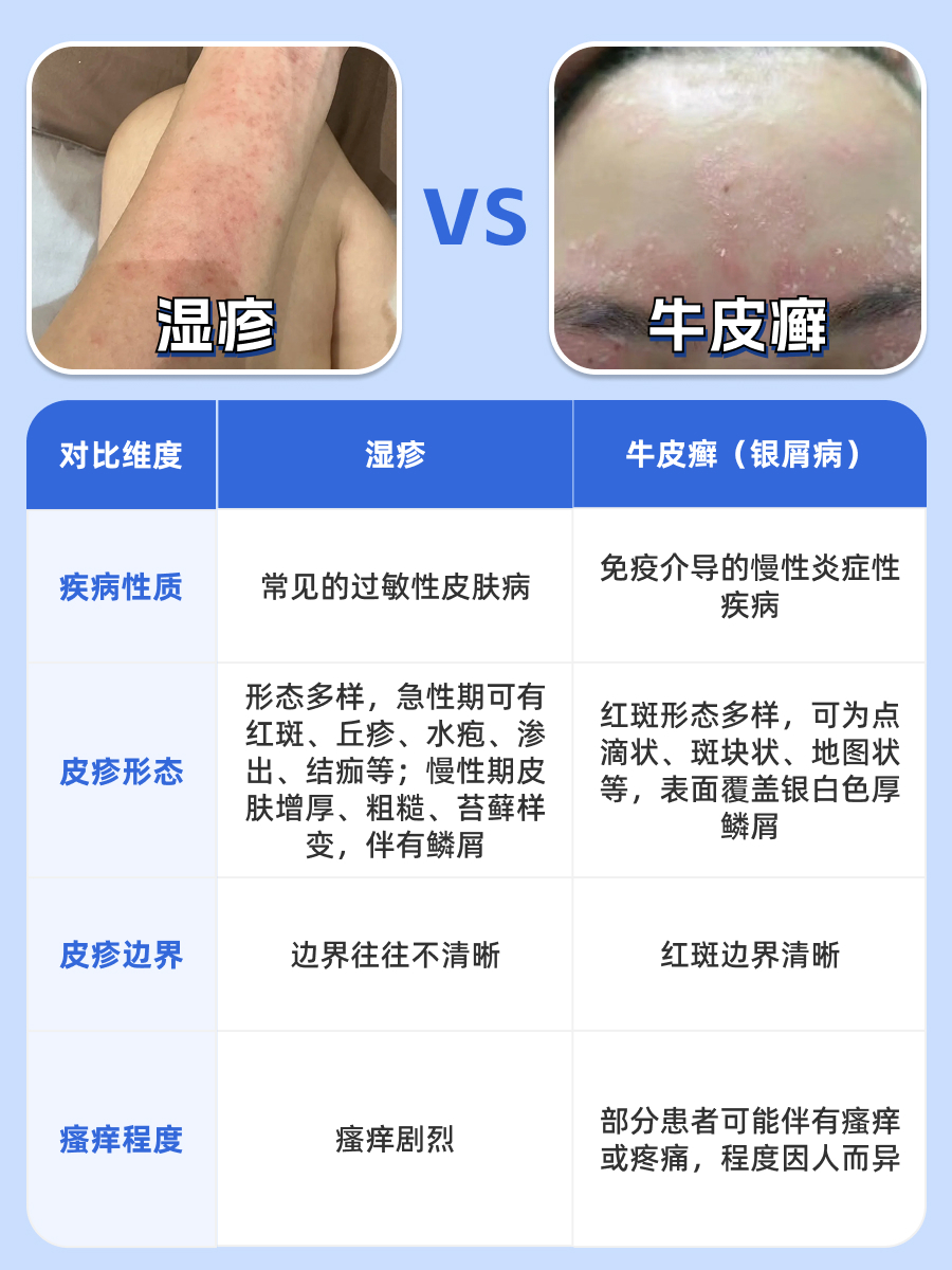 什么容易误诊成银屑病？皮肤科医生来揭秘
