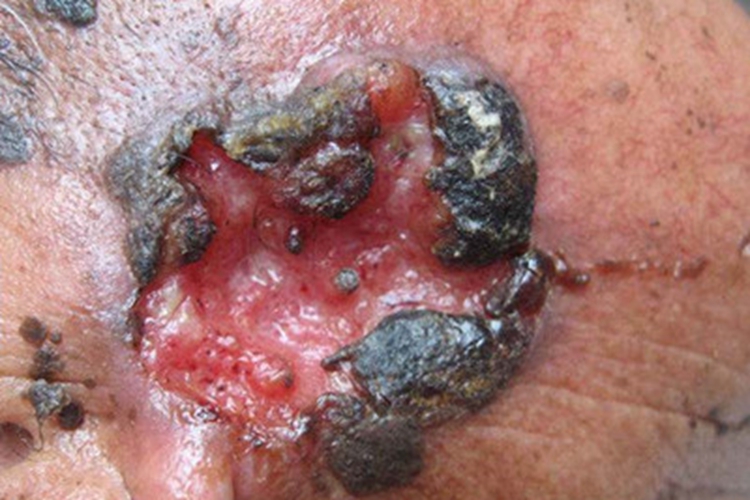 下疳样脓皮病溃疡图