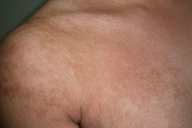 咖啡斑胸部症状图