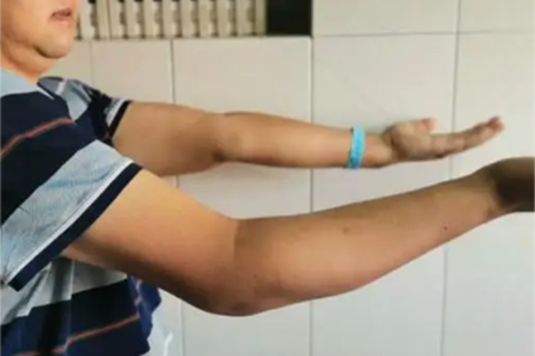 肘外翻手臂弯曲变形图