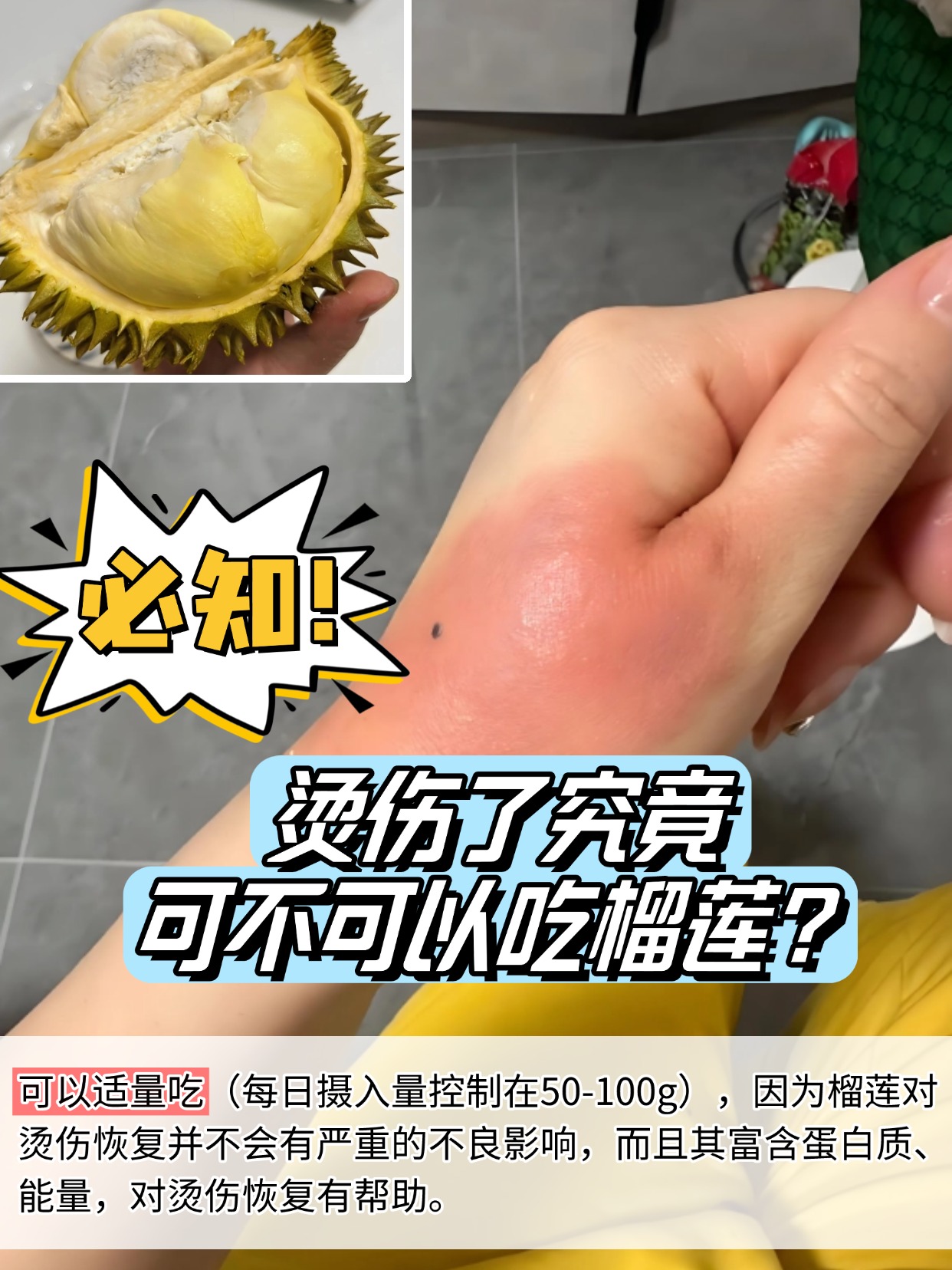 必知！烫伤了究竟可不可以吃榴莲？
