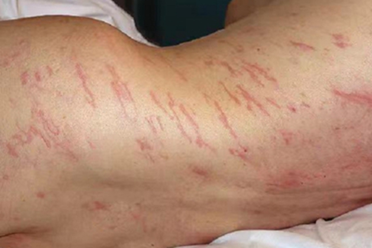 皮肤幼虫移行症腰部症状图