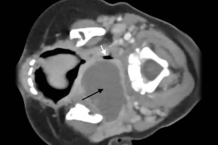 扁桃体脓肿CT图