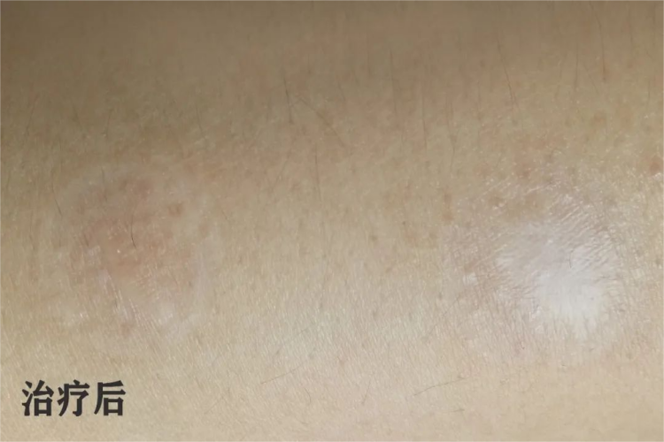 烟疤手术后图 烟疤手术后图