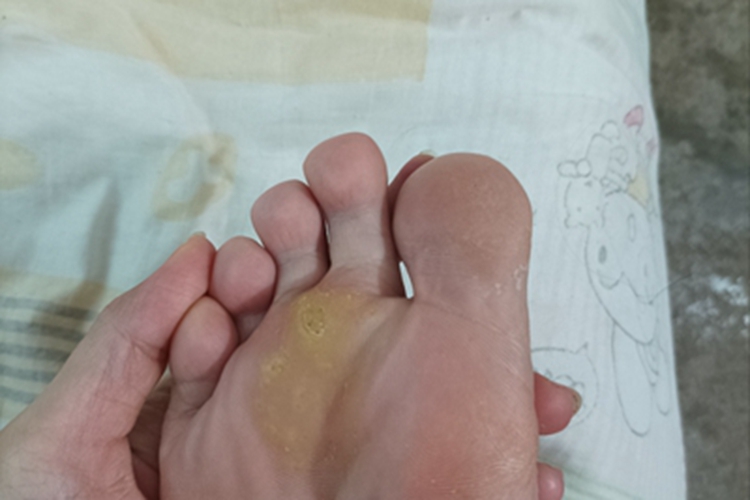寻常疣脚底皮肤增厚图