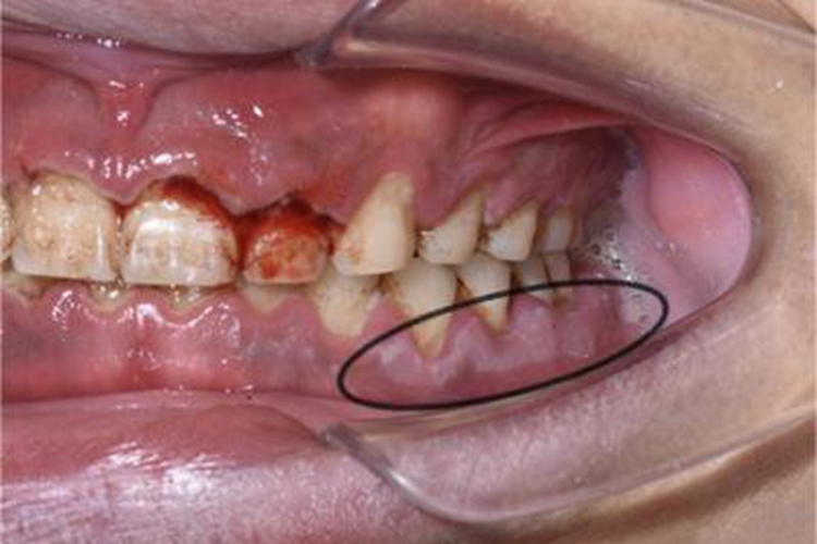 急性坏死性溃疡性龈炎牙龈糜烂图