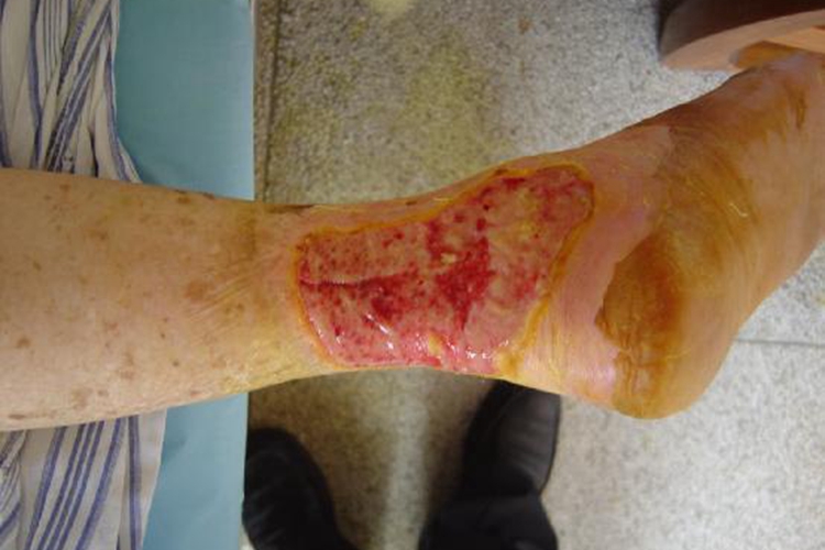 烫伤体液渗出期图