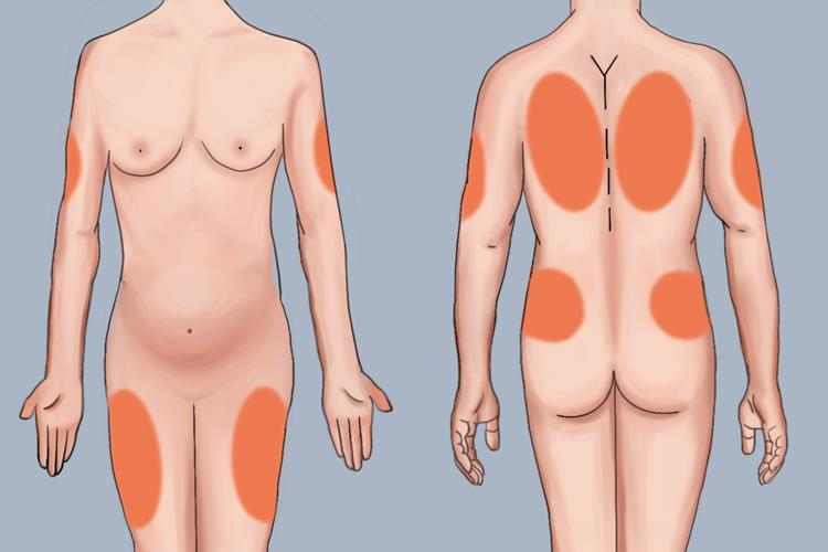 孕妇肝素注射部位图 孕妇肝素注射部位图