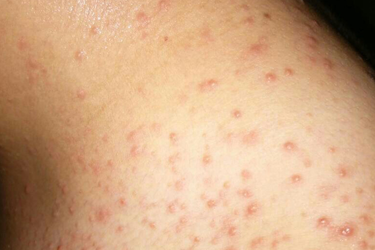 艾滋病身上的疙瘩照片_有来医生