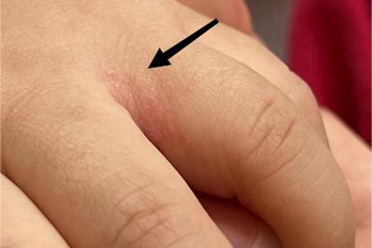 体癣手部丘疹图 体癣手部丘疹图