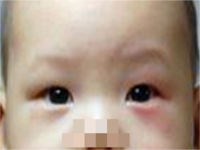 儿童过敏性结膜炎眼睛肿的红红的图.png