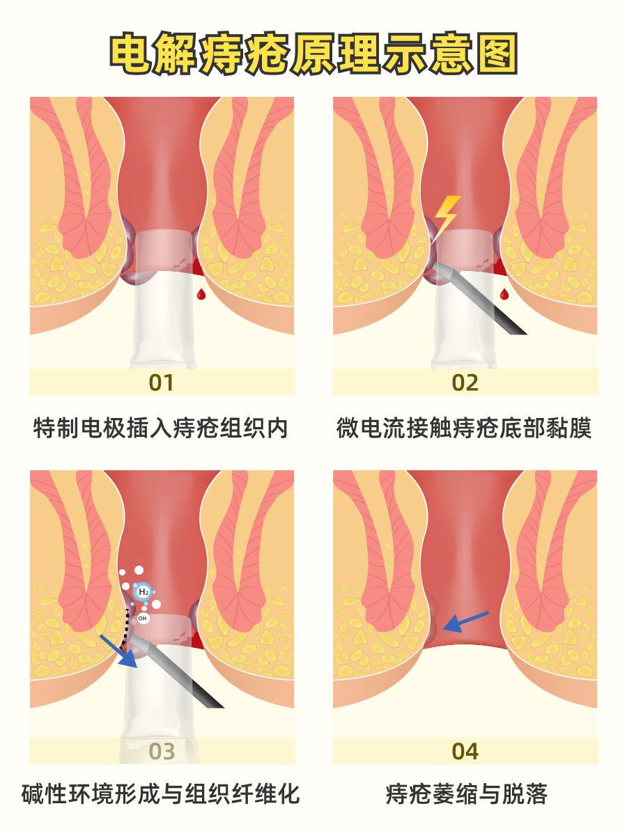 杭州电解痔疮攻略 | 原理、专家推荐与术后护理全知道