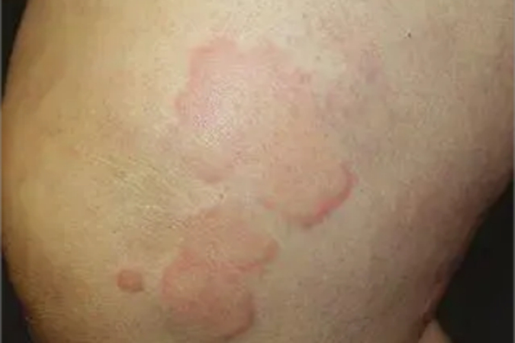 胆碱能性荨麻疹膝盖风团图 胆碱能性荨麻疹膝盖风团图