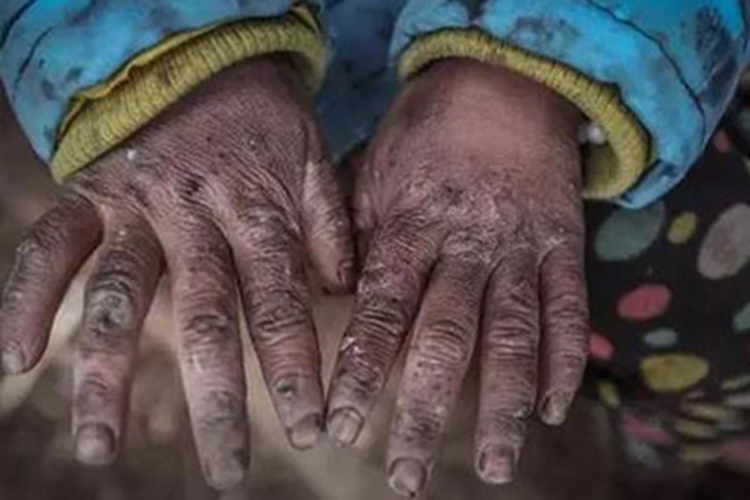 Ⅲ度冻伤手指症状图