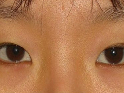 内眦赘皮左眼内眼角向下拖图.jpeg