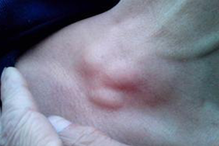 颈部淋巴结结核